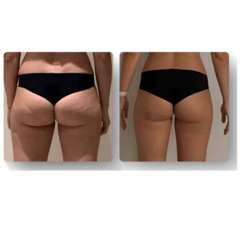 LuxeSilhouette Anticellulite Massager | Verhoog je huidroutine met een premium verjongende massager