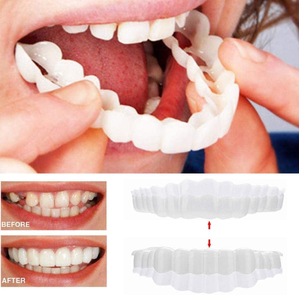 Op Smile Veneers (boven- en onderkaak inbegrepen)
