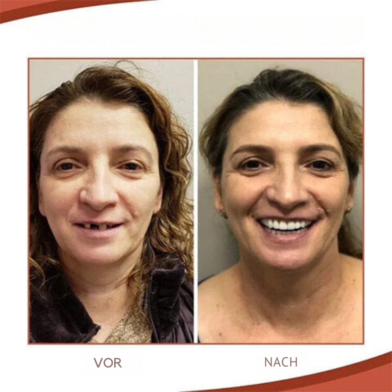 Biocompatibele Siliconen Prothesen Set voor Pijnvrije Pasvorm en Natuurlijke Glimlach