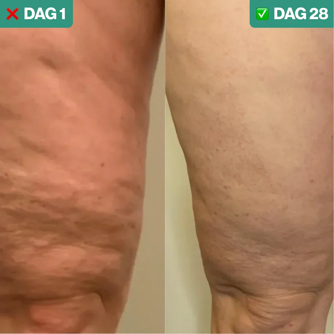 SmoothLift | Anti-Cellulite & Huidverstrakking Behandeling