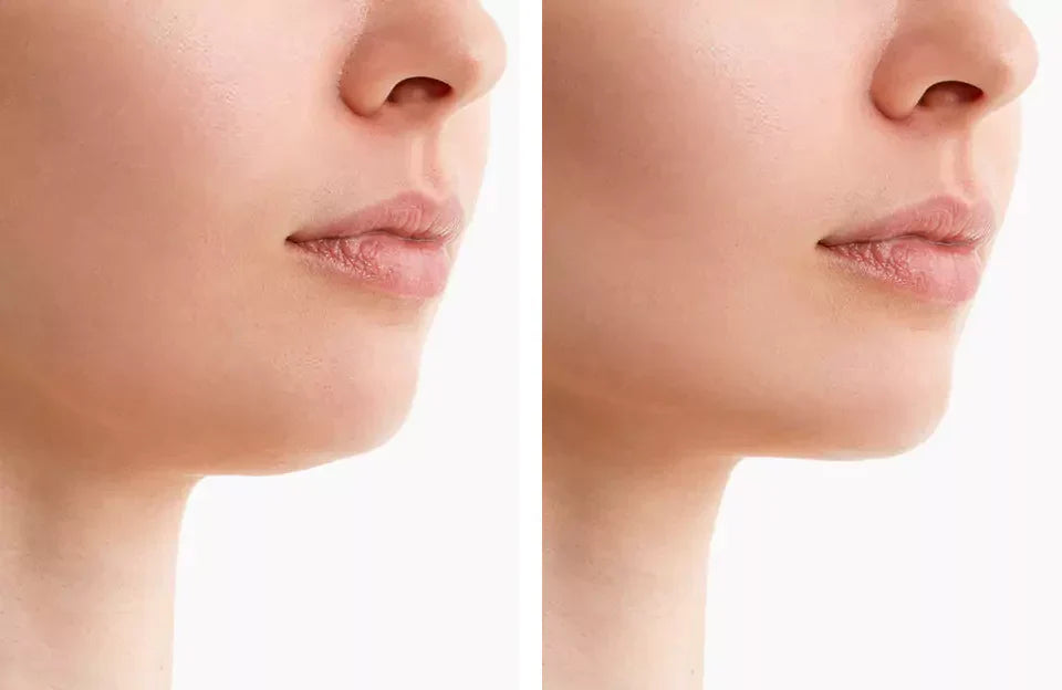 NovaLume ChinContour Rood Licht Band Voor Dubbele Kin