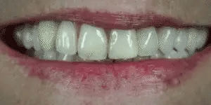 Snap-On Veneers Van NovaBright Creëer Snel, Natuurlijk Lijkende Glimlach Voor Boven- En Onderste Tanden