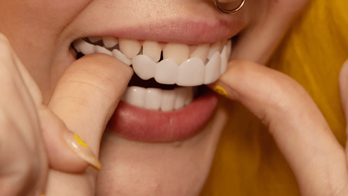Snap-On Veneers Van NovaBright Creëer Snel, Natuurlijk Lijkende Glimlach Voor Boven- En Onderste Tanden