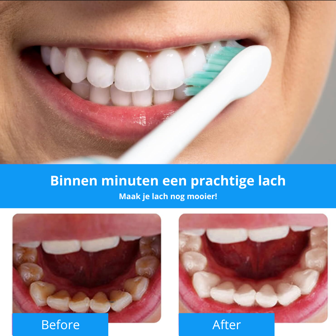 WhiteSmile | Een stralende lach binnen minuten | Combideal