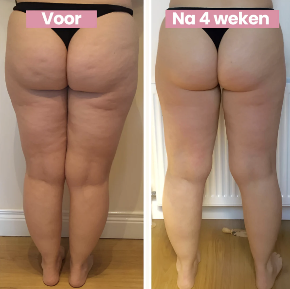 SmoothLift | Anti-Cellulite & Huidverstrakking Behandeling