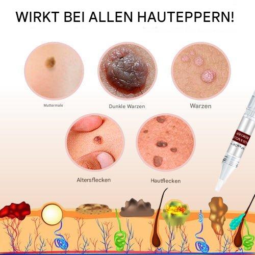 WartOff Huidvlekken Verwijderaar Pijnloos Natuurlijke Formule 1 Plus 1 Gratis