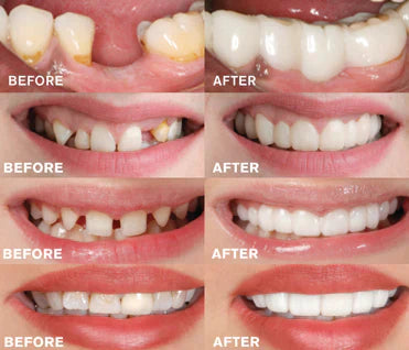 Sandsberg Foldable Teeth 1+1 Free