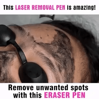 LumiDerm Thuis Laser Pen voor Tattoo Verwijdering, Moedervlekken en Vlekken