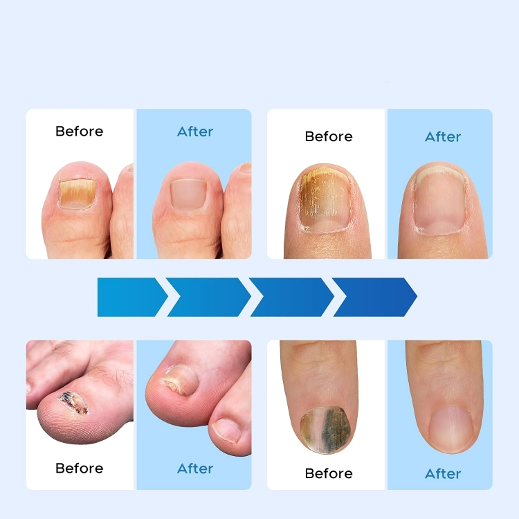 LuxeNail | Antischimmelbehandeling voor nagels – effectief – snel – natuurlijk