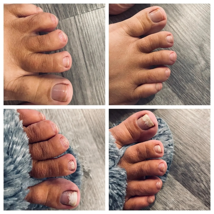 LuxeNail | Antischimmelbehandeling voor nagels – effectief – snel – natuurlijk