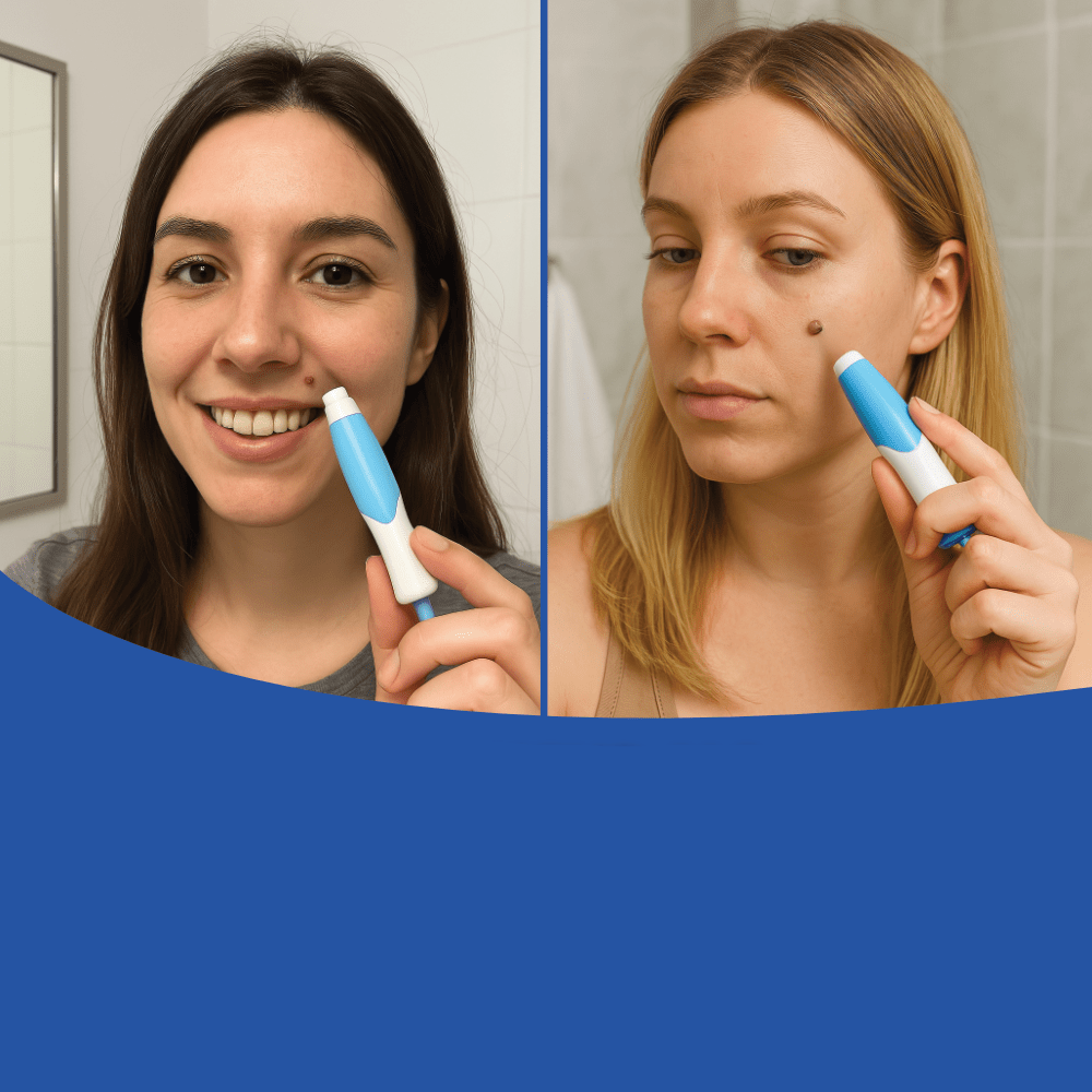 LuxuraCare Professionele Wratverwijderaar | Effectieve oplossing voor de zachte verwijdering van steelwratten