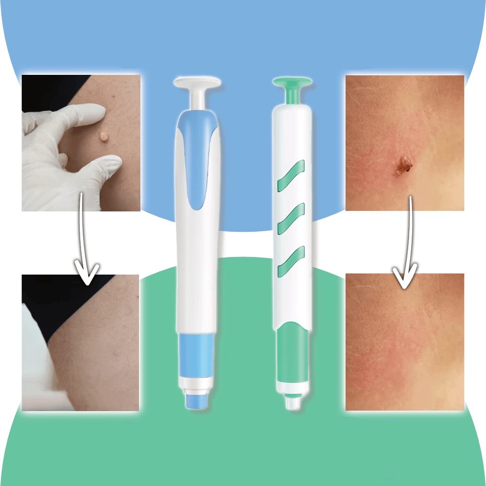 LuxuraCare Professionele Wratverwijderaar | Effectieve oplossing voor de zachte verwijdering van steelwratten